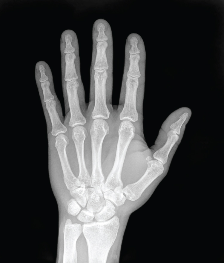 Left Hand X-Ray